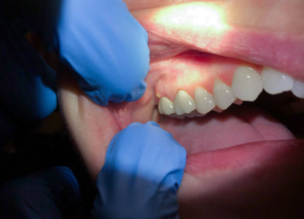Best Broken or Chipped Tooth Repair in Granite Falls, NC